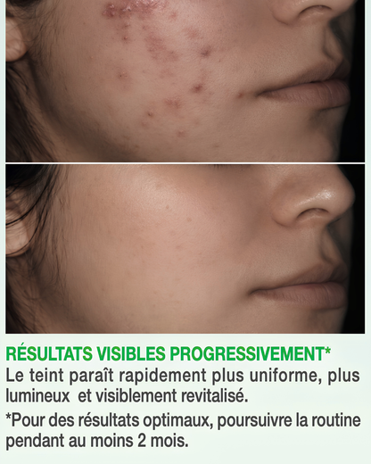 Coffret Zéro Tache – 3 Soins Essentiels Jour &amp; Nuit - Peaux mixtes à grasses